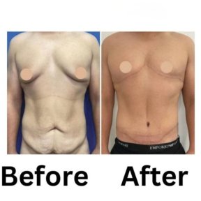before-after photo gynecomastia-surgery
