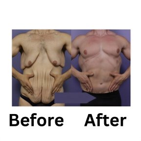 before-after photo gynecomastia-surgery