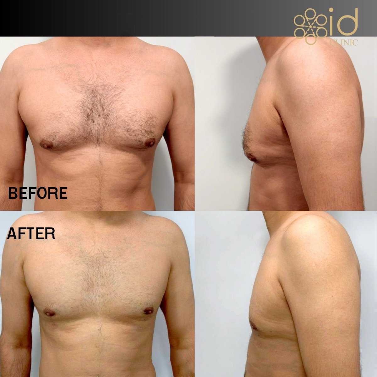 Resultados antes y después de liposucción Vaser en ID Clinic Bangkok, mejor contorno torácico