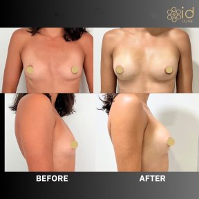 before-after photo breast-augmentation