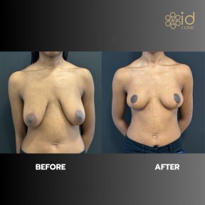 before-after photo mastopexy-breast-lift-contour-plastics