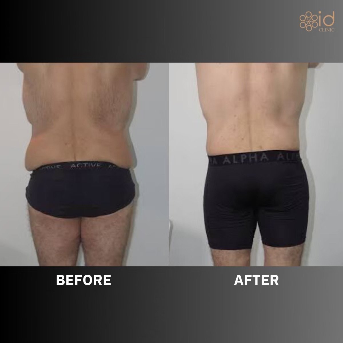 Resultados antes y después de Vaser liposucción en ID Clinic Bangkok, mejor contorno lumbar