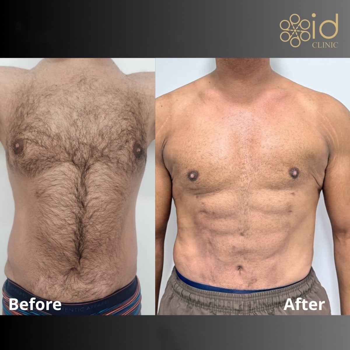 Resultados de Vaser liposucción antes y después en ID Clinic Bangkok, abdomen masculino definido