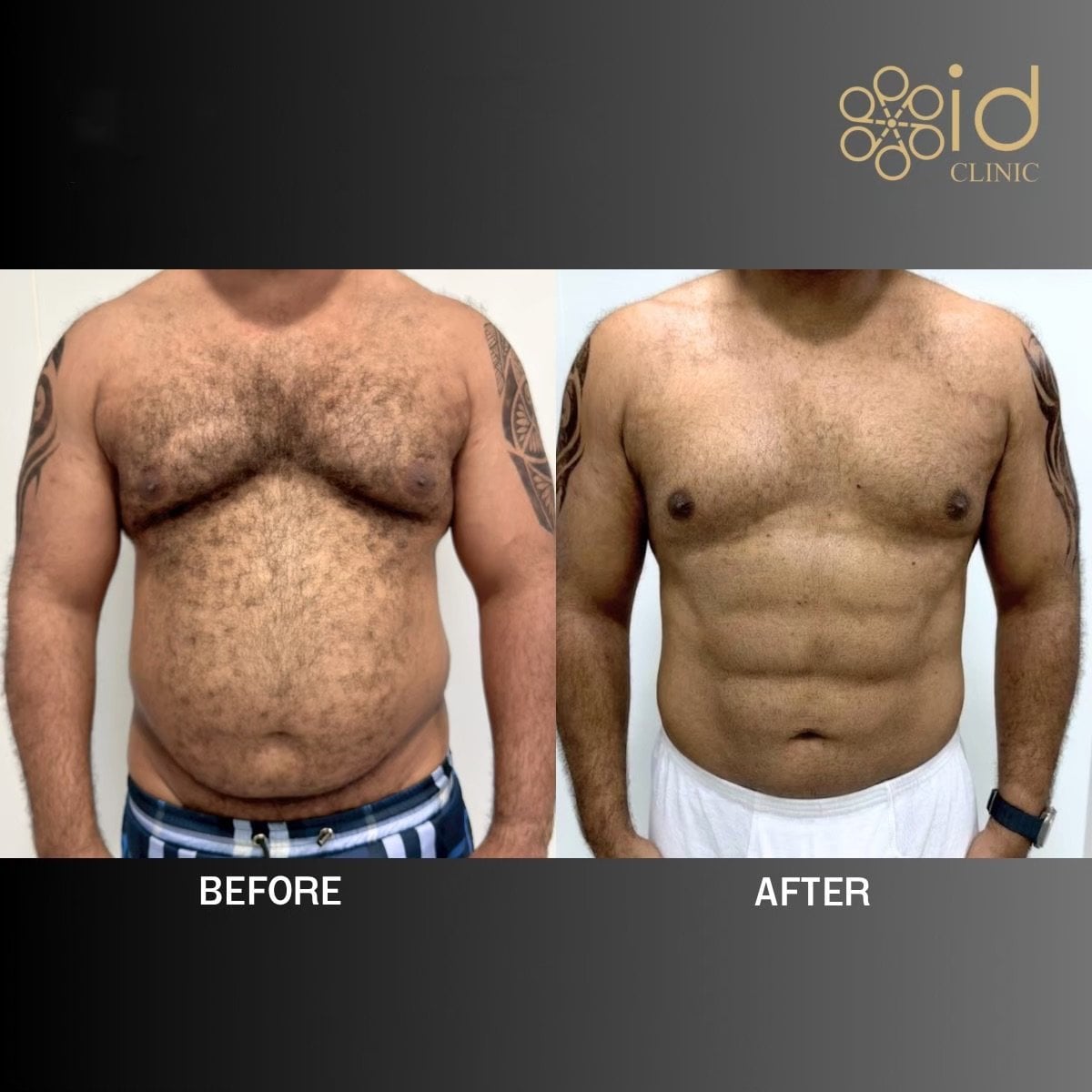 نتائج شفط الدهون فايزر قبل وبعد في ID Clinic Bangkok، تحسين شكل جسم الرجل