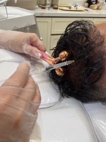 before-after photo treatment-with-stem-cells