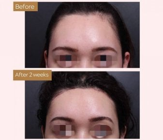 before-after photo lifting-lba