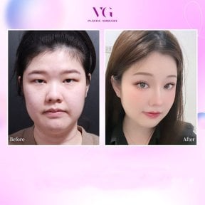 before-after photo blepharoplasty-eyelid