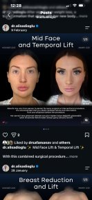 before-after photo endoskopicheskaya-podtyazhka-lica
