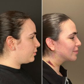 before-after photo endoskopicheskaya-podtyazhka-lica