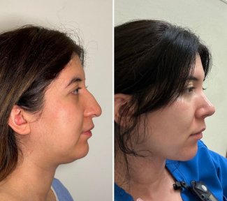 before-after photo endoskopicheskaya-podtyazhka-lica