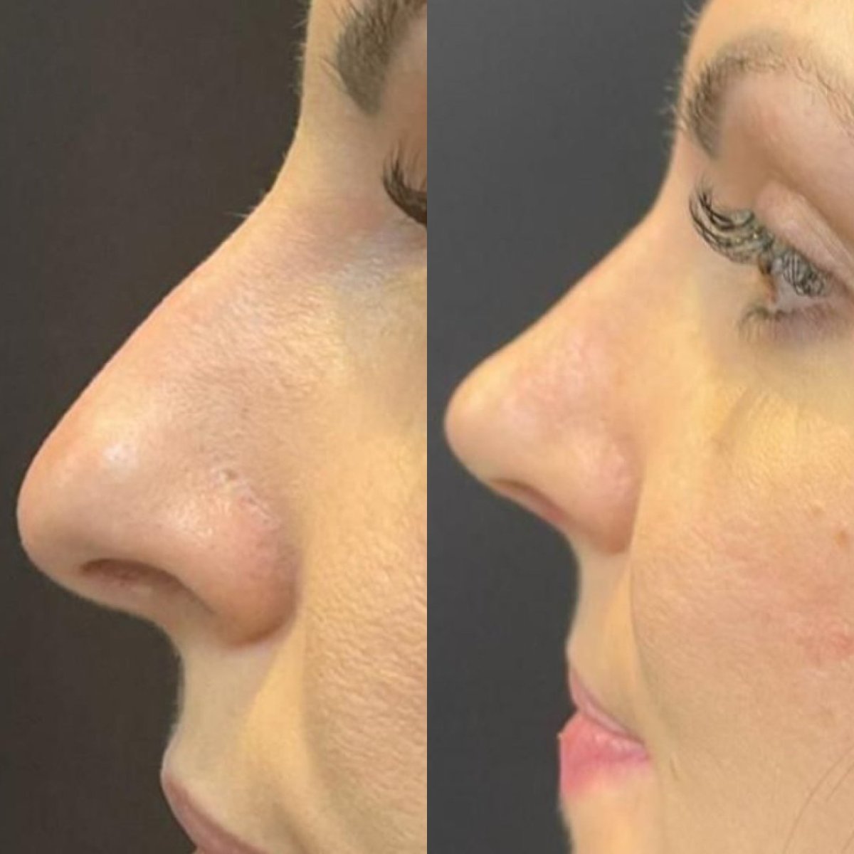 نتائج عملية تجميل الأنف قبل وبعد في Dr. Fabiano Arruda – Plastic Surgery، إعادة تشكيل الأنف