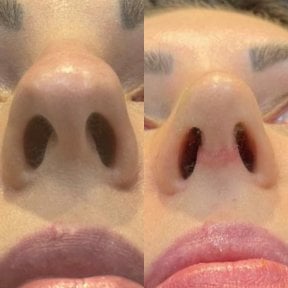 before-after photo rhinoplasty-nose-job
