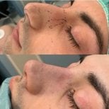 Before and after ultrasonic rhinoplasty result at Dr. Fabiano Arruda – nose reshaping visible