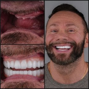 before-after photo dental-implant