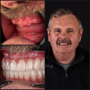 before-after photo dental-implant