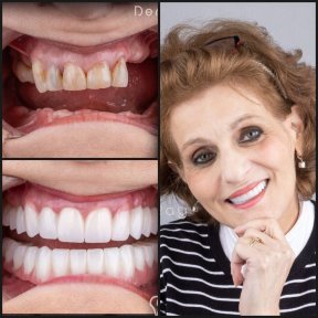 before-after photo all-on-4-dental-implants