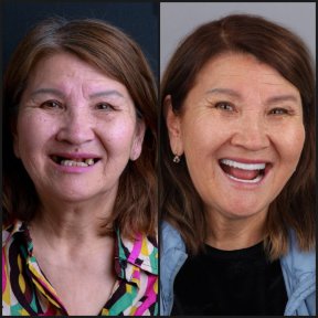 before-after photo all-on-4-dental-implants
