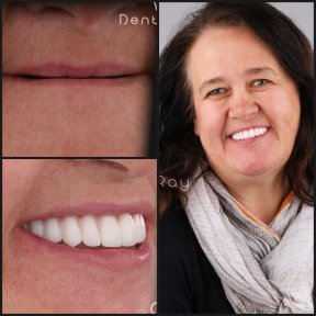 before-after photo all-on-4-dental-implants