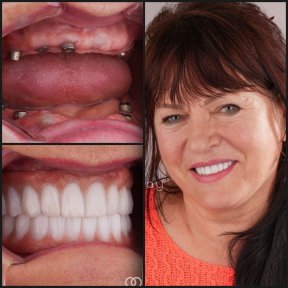 before-after photo all-on-4-dental-implants