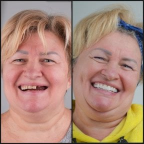 before-after photo all-on-4-dental-implants