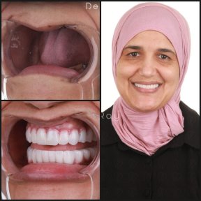 before-after photo all-on-4-dental-implants