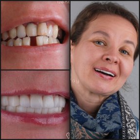 before-after photo all-on-4-dental-implants