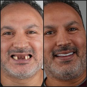 before-after photo installation-of-a-dental-implant-with-crown