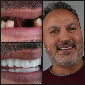 before-after photo all-on-6-dental-implants