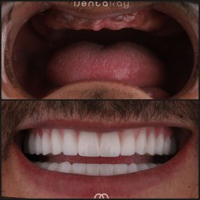 before-after photo all-on-6-dental-implants