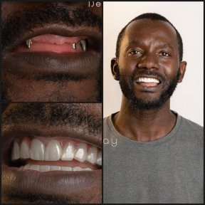 before-after photo all-on-6-dental-implants