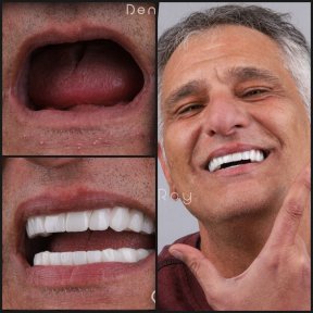 before-after photo all-on-6-dental-implants