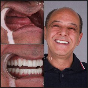 before-after photo all-on-6-dental-implants