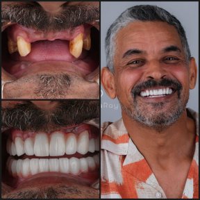 before-after photo all-on-4-dental-implants