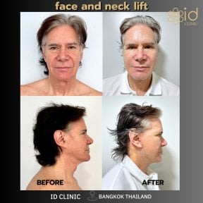 Before and after facelift and neck lift results at ID Clinic Bangkok, visible facial rejuvenation