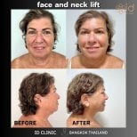 Before and after facelift and neck lift results at ID Clinic Bangkok, visible facial rejuvenation