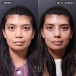 Результаты до и после этнической ринопластики в VG Plastic Surgery, улучшение формы носа