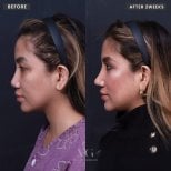 Результаты этнической ринопластики до и после в VG Plastic Surgery, коррекция носа за 2 недели