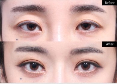 Before and after double eyelid surgery results at VG Plastic Surgery, enhanced eyelid crease