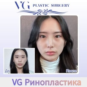 Before and after tip rhinoplasty result at VG Plastic Surgery, nose reshaping improvement