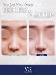 Before and after tip rhinoplasty results at VG Plastic Surgery, nose reshaping improvement