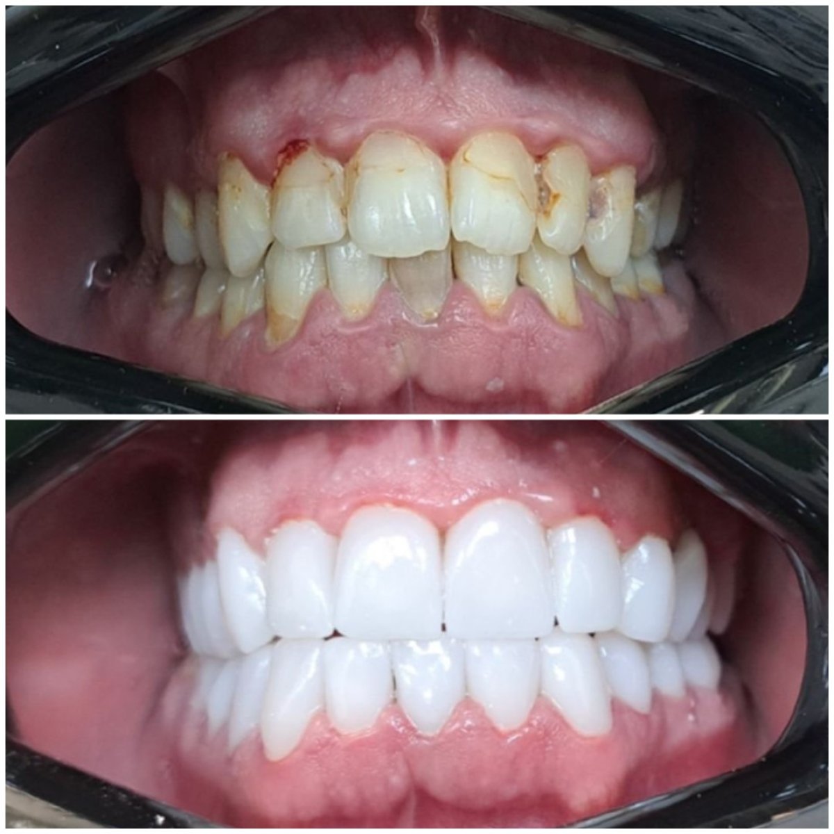 Antes y después de coronas de zirconio en AllDental – resultados de restauración de sonrisa