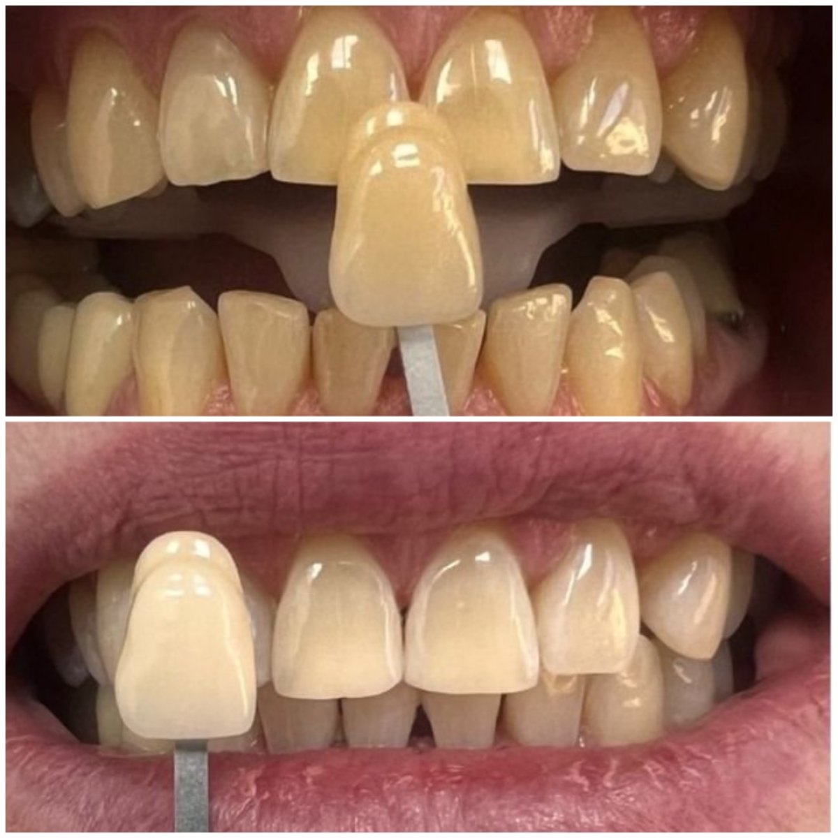 Resultados de blanqueamiento dental antes y después en AllDental – dientes más blancos
