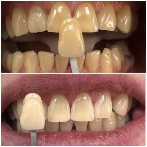 Before and after tooth whitening results at AllDental – visibly brighter and whiter teeth
