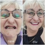 Before and after zirconia crown installation at AllDental – smile makeover results