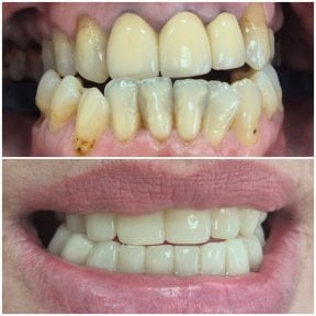 Before and after dental crown installation results at AllDental – improved smile and whiter teeth