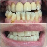 Before and after dental crown installation results at AllDental – improved smile and whiter teeth