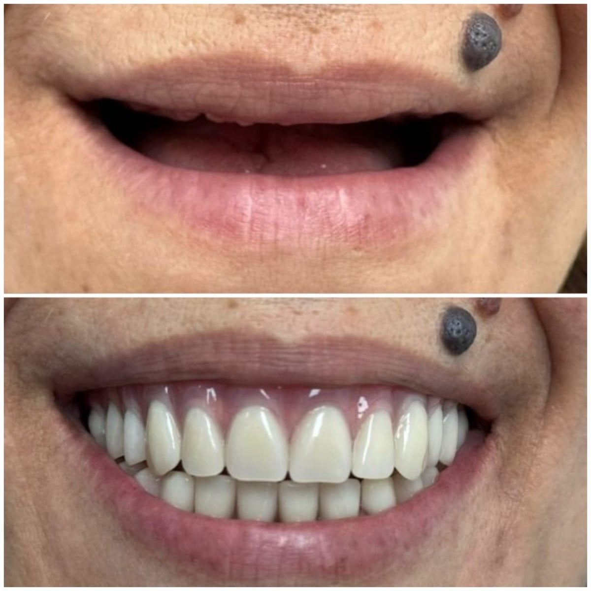 Resultados antes y después de implantes All-on-4 en AllDental – restauración total de la sonrisa