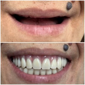 Resultados antes y después de implantes All-on-4 en AllDental – restauración total de la sonrisa