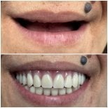 Resultados antes y después de implantes All-on-4 en AllDental – restauración total de la sonrisa