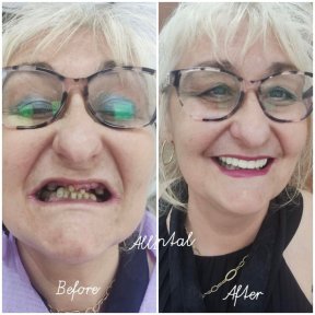 Before and after dental crown installation at AllDental – smile restoration results